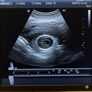 breast ultrasound
